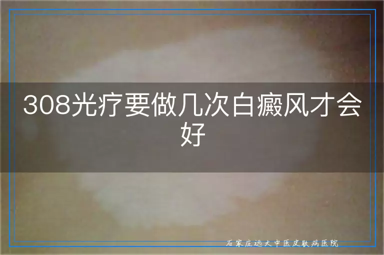 308光疗要做几次白癜风才会好