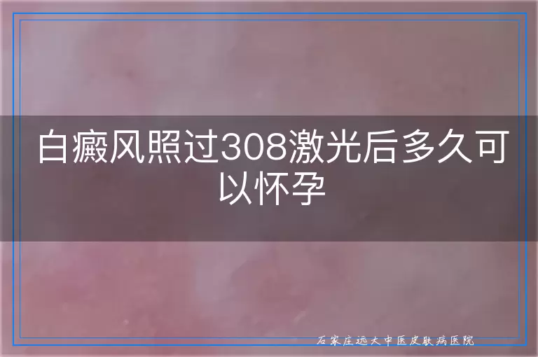 白癜风照过308激光后多久可以怀孕