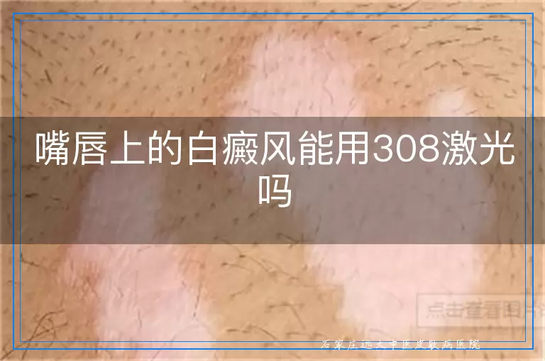 嘴唇上的白癜风能用308激光吗