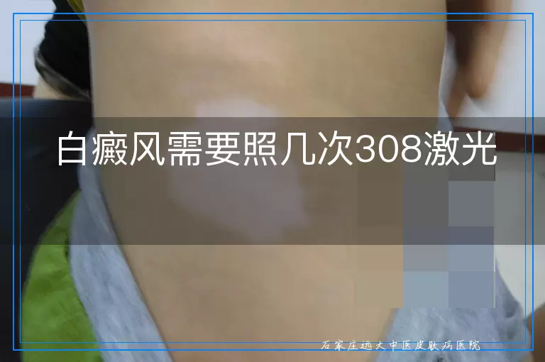 白癜风需要照几次308激光