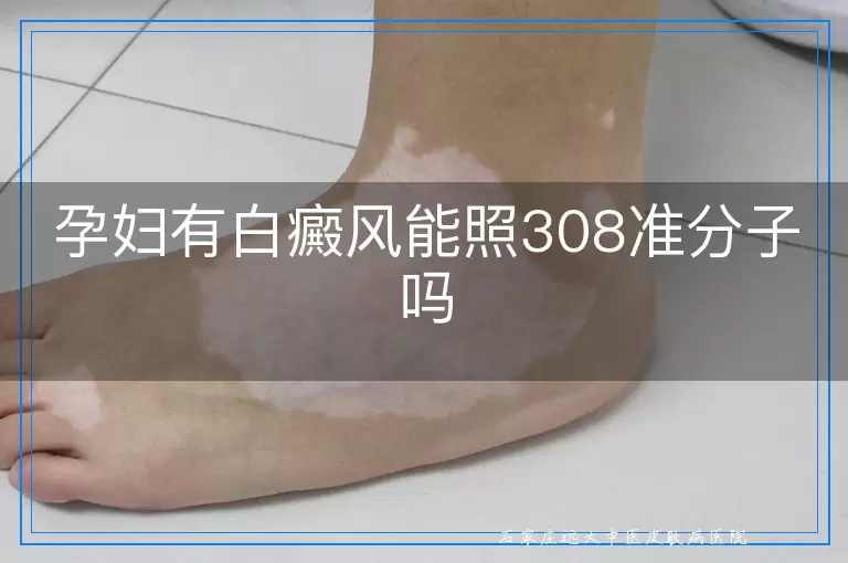 孕妇有白癜风能照308准分子吗