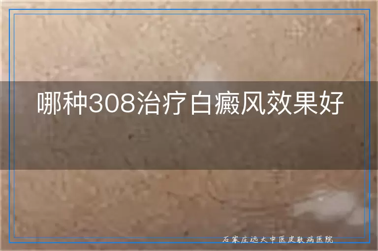 哪种308治疗白癜风效果好