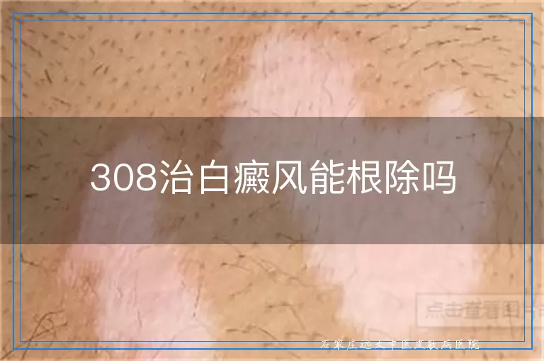 308治白癜风能根除吗