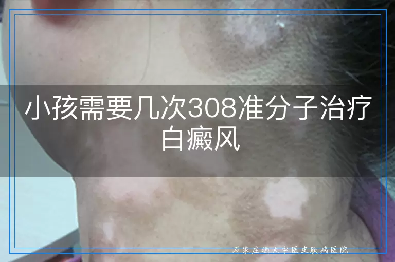 小孩需要几次308准分子治疗白癜风