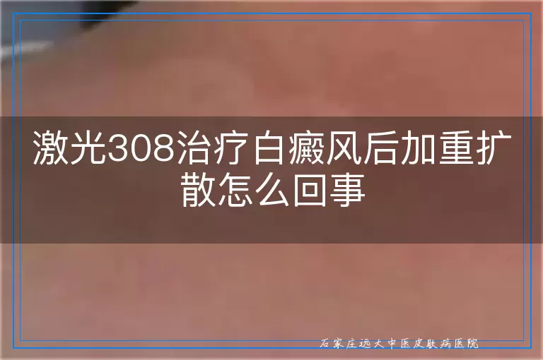 激光308治疗白癜风后加重扩散怎么回事