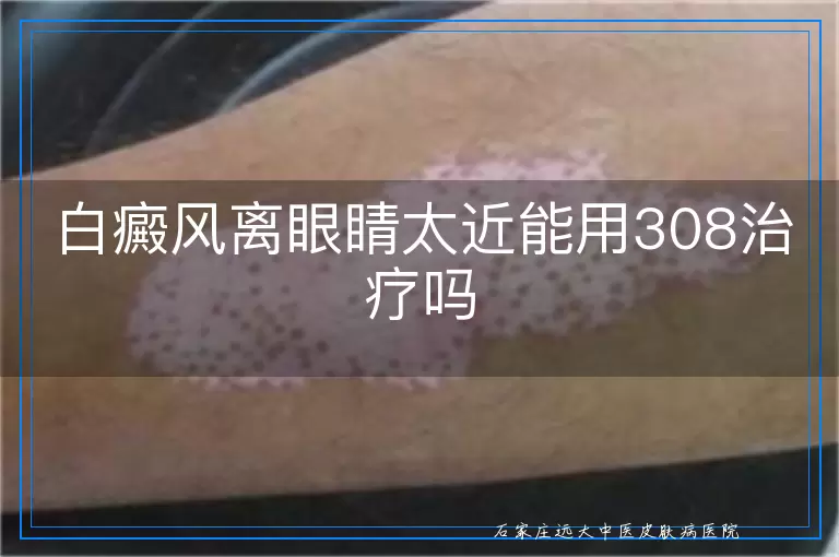 白癜风离眼睛太近能用308治疗吗