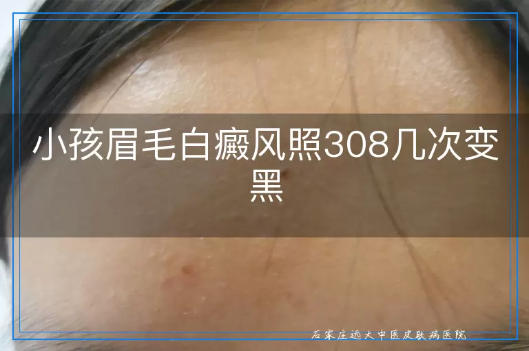 小孩眉毛白癜风照308几次变黑