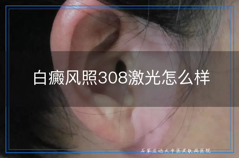 白癜风照308激光怎么样