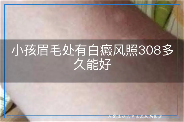 小孩眉毛处有白癜风照308多久能好