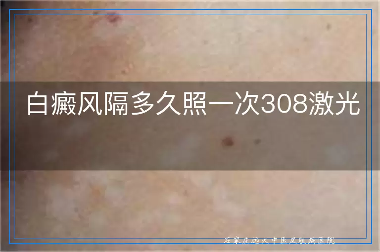 白癜风隔多久照一次308激光