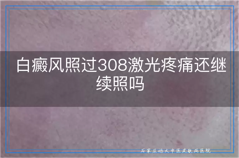 白癜风照过308激光疼痛还继续照吗