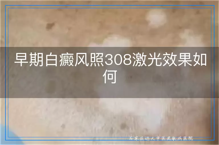 早期白癜风照308激光效果如何