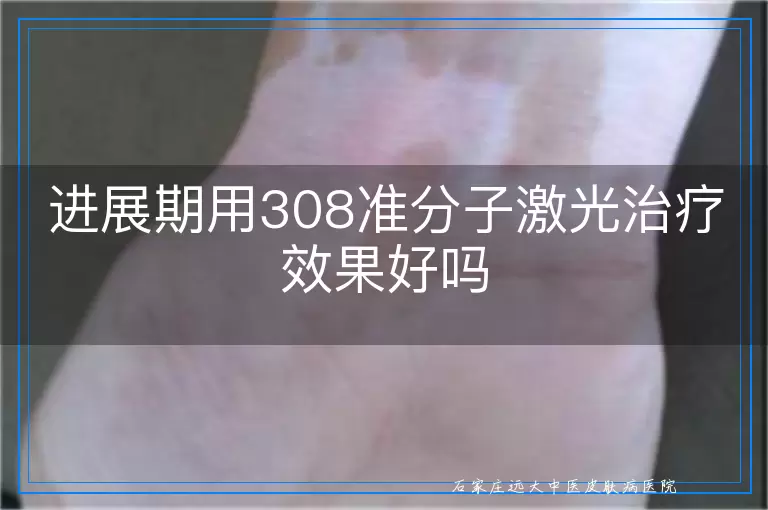 进展期用308准分子激光治疗效果好吗