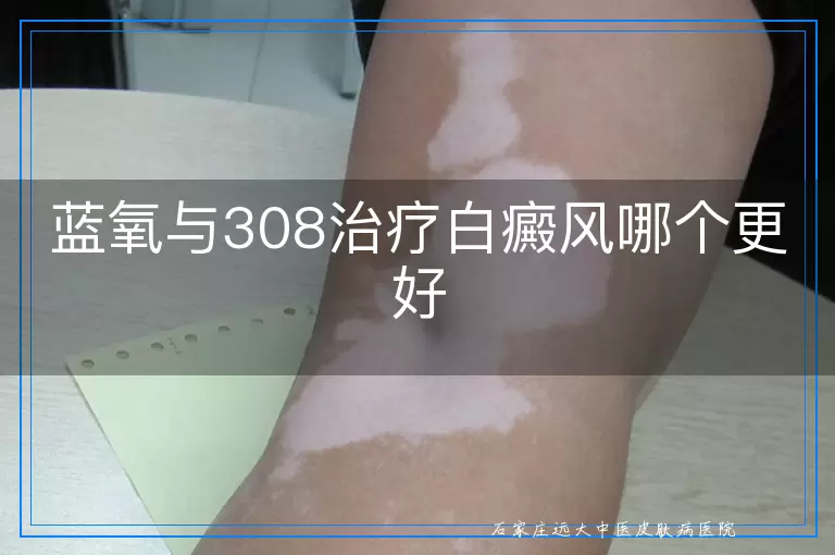 蓝氧与308治疗白癜风哪个更好