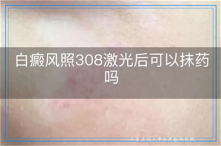 白癜风照308激光后可以抹药吗