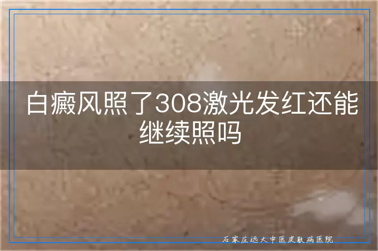 白癜风照了308激光发红还能继续照吗