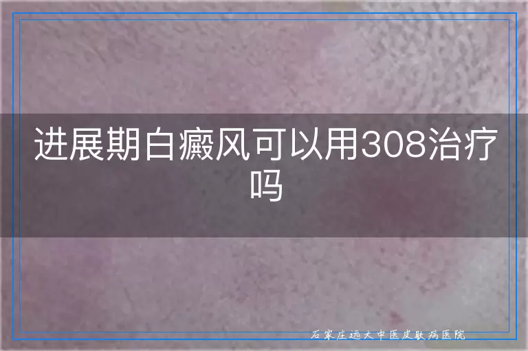 进展期白癜风可以用308治疗吗