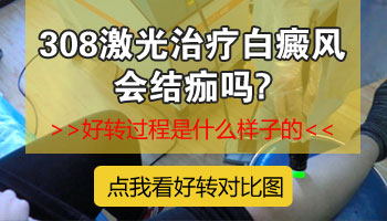 处在发展期的白斑照UVB能治疗好吗